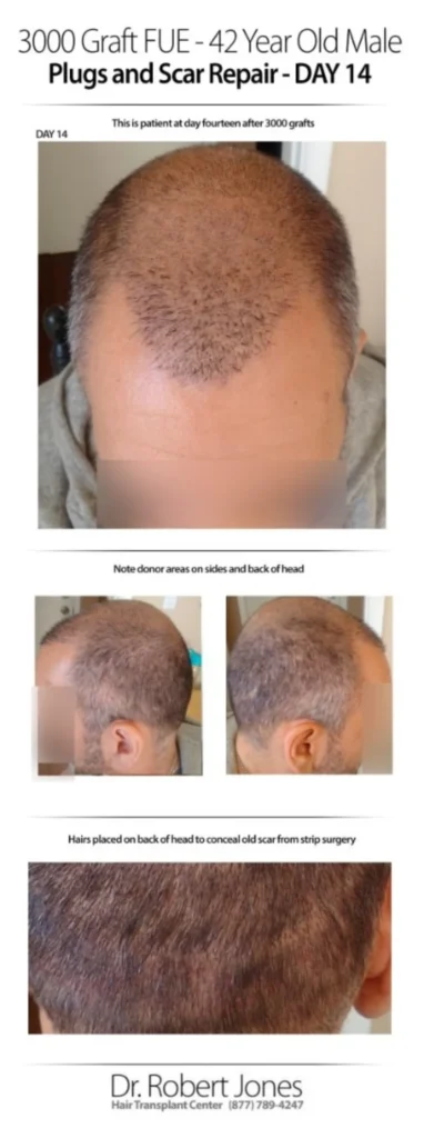 3000 Graft FUE 42 Years-Old-Male-Before-and-After-Day-14