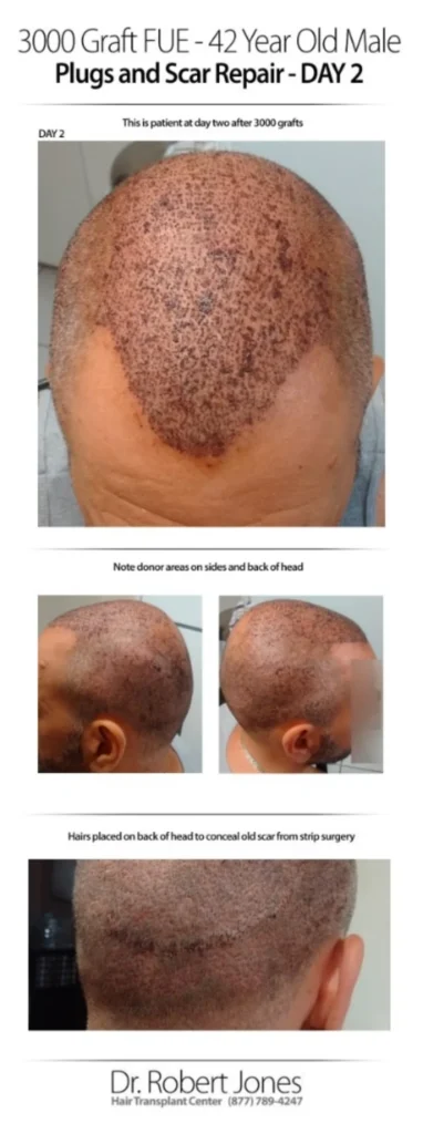 3000 Graft FUE 42 Years Old Male Before And After Day-2