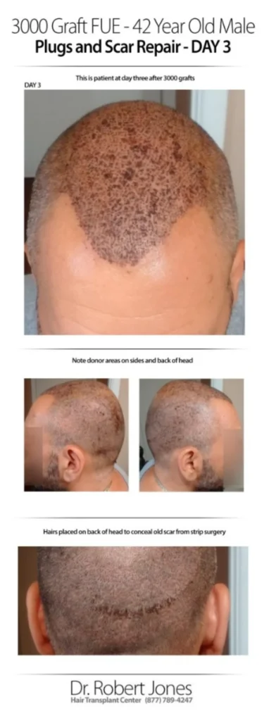 3000 Graft FUE 42 Years Old Male Before And After Day-3