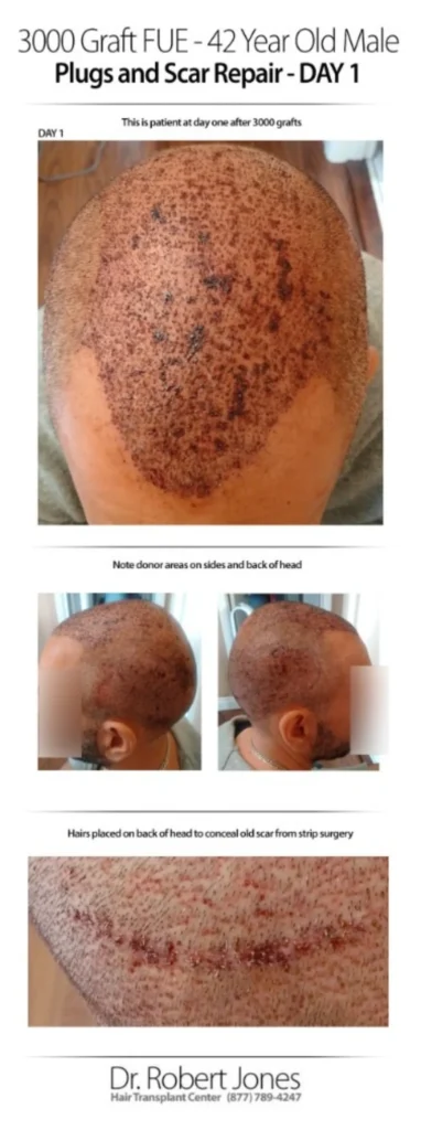 3000 Graft FUE 42 Years Old Male Before And After Day-1