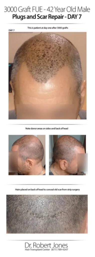 3000 Graft FUE 42 Years Old Male Before And After Day-7