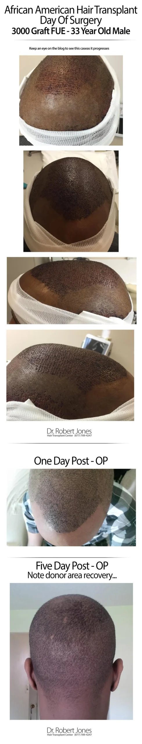 Dr Jones African American 3000 Graft FUE