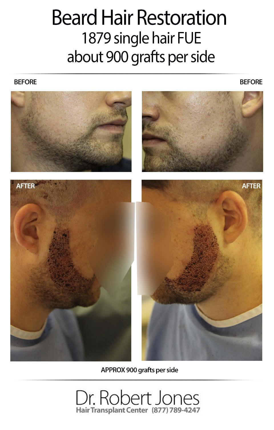 Beard Transplant 1800 Grafts Day Of Surge