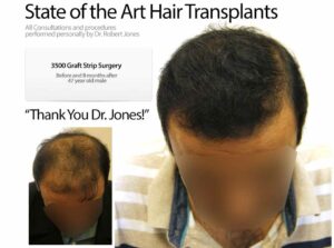 3500 Graft Hair Transplant Before And After