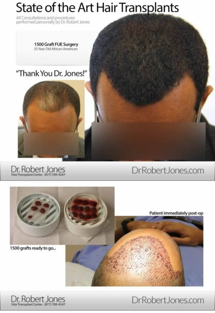 1500 Graft FUE African American