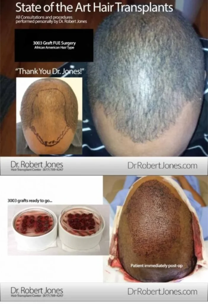 3000 Graft FUE 35 Year Old Before and After