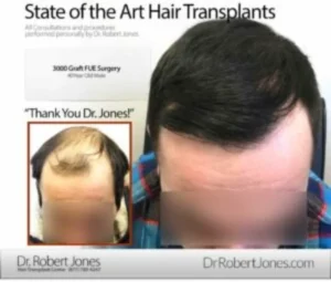 3000 Graft FUE Before And After