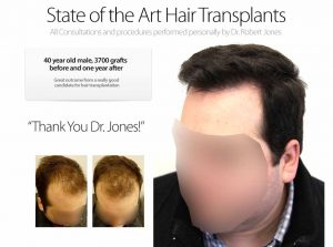 5 Secrets Care Hair Transplant