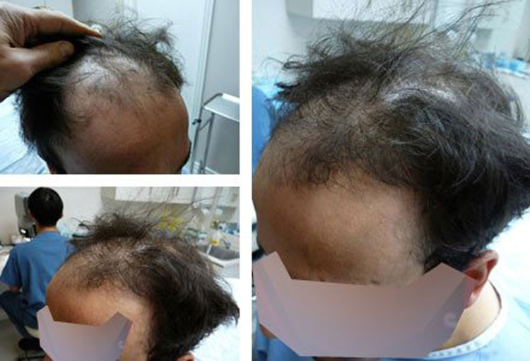 Case Study - 3800 Graft Strip Hair Transplant | Dr Robert Jones