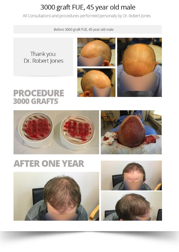3000 Graft Fue, 45 Year Old Male Before and After