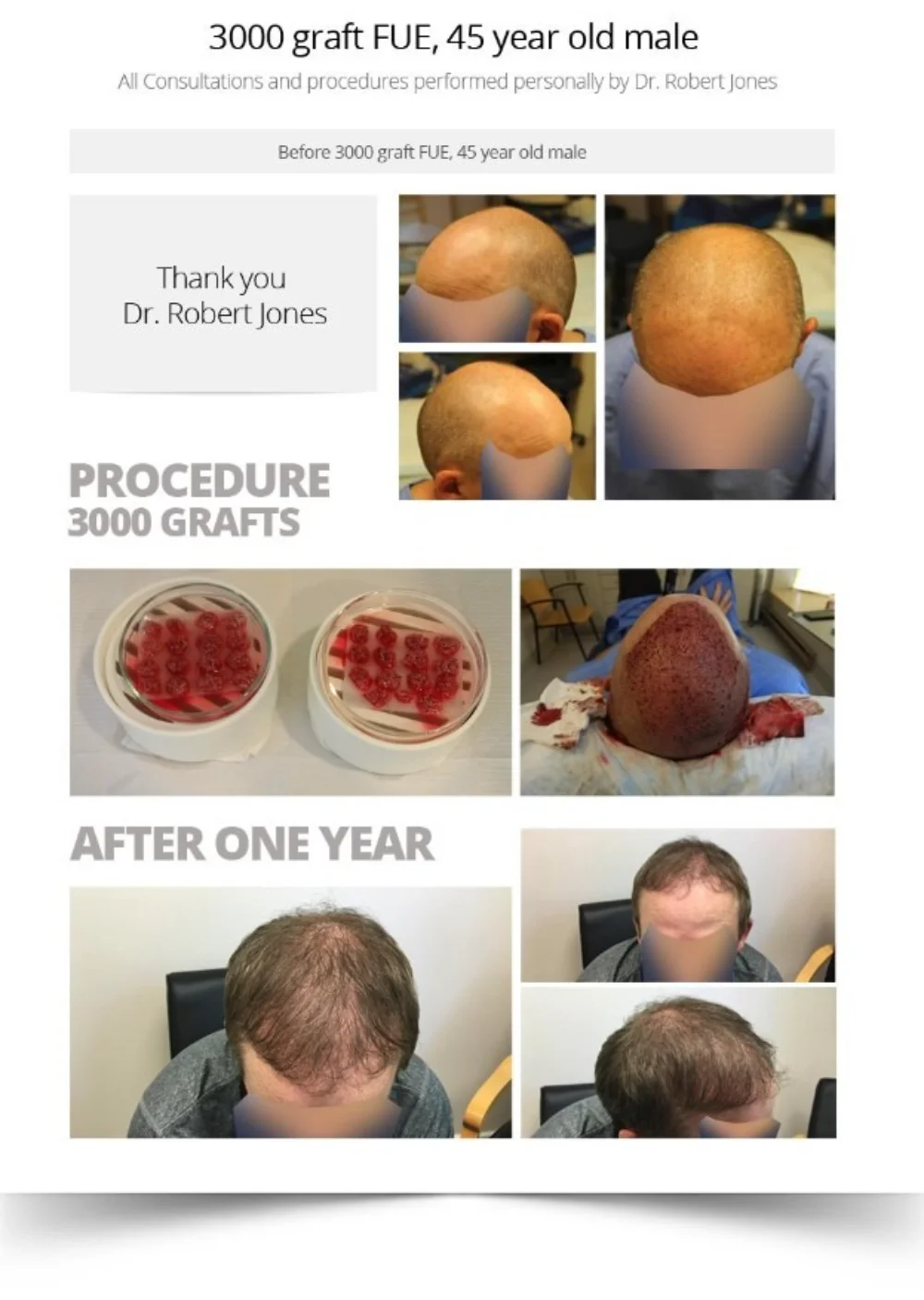 3000 Graft Fue 45 Year Old Male Before And After