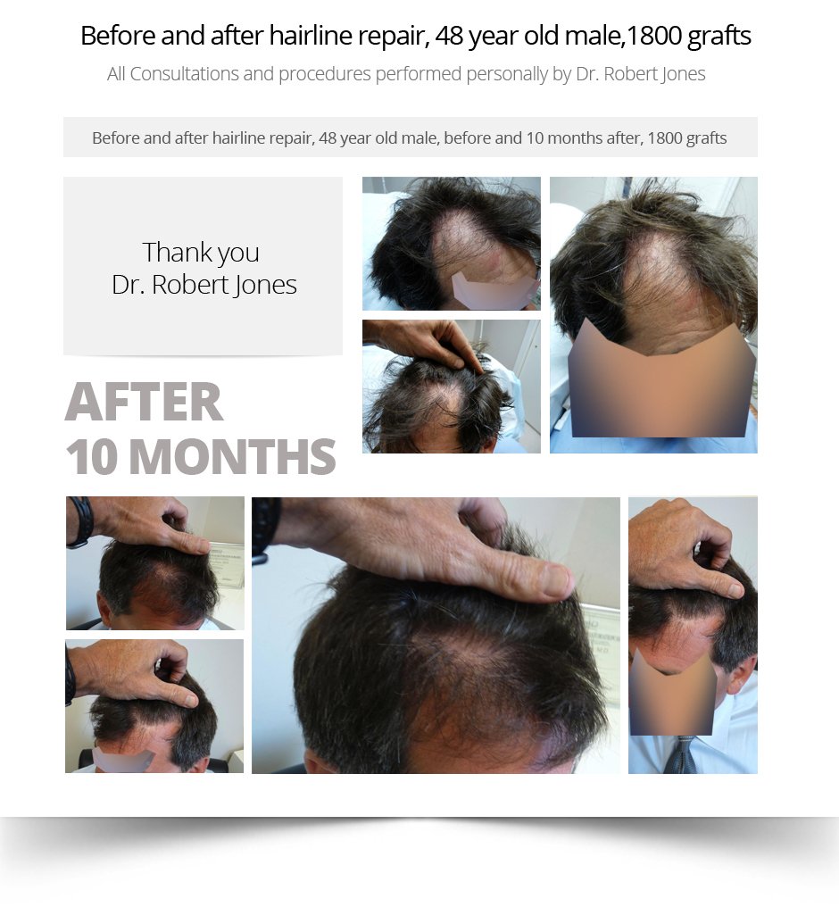 Case-Study-3-Before-and-After-hairline-repair-48-y-img-1