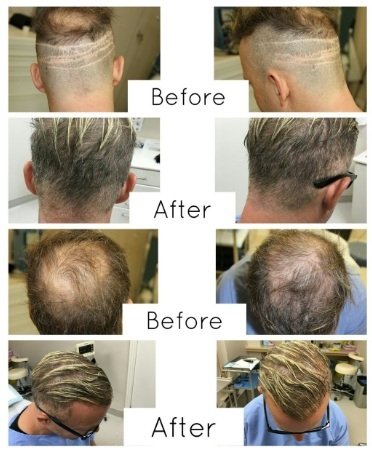 Hair Transplant Procedure at Toronto Clinic