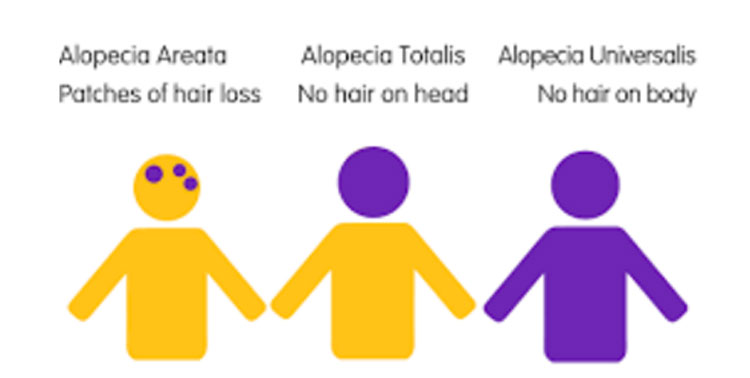 different-types-of-alopecia-dr-robert-jones