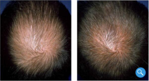 Hair Loss Solution Before and After