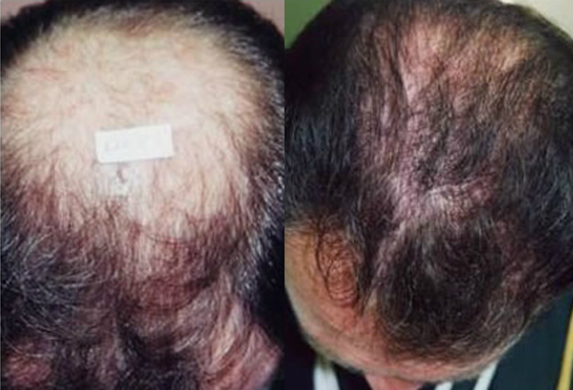 Before and After Crown Procedure, 1200 Follicular Units