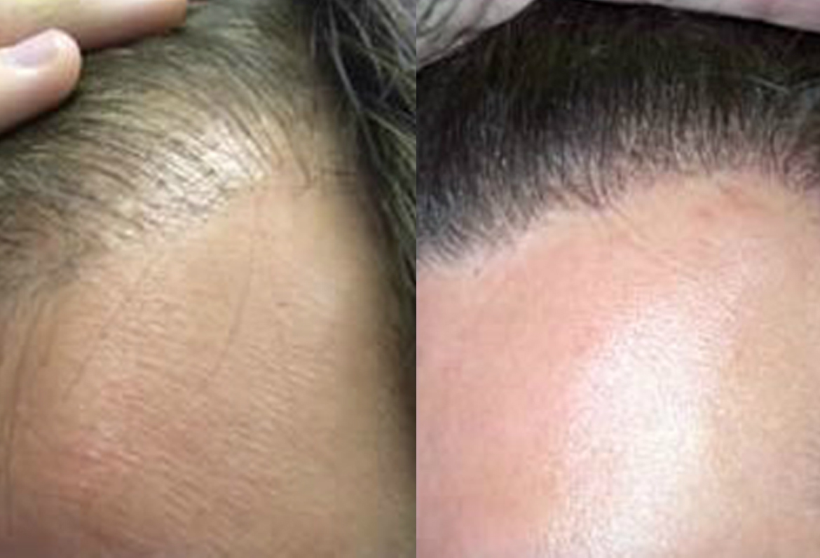 Before and After Hair-Line Procedure, 1500 FUE Grafts
