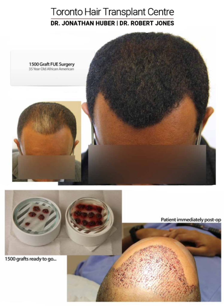 Before And After 1500 Grafts FUE Procedure