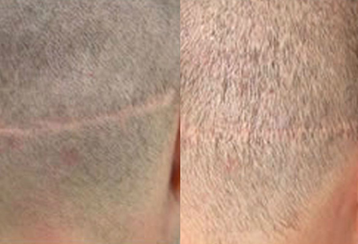 Before and After Scar Repair, 200 Grafts