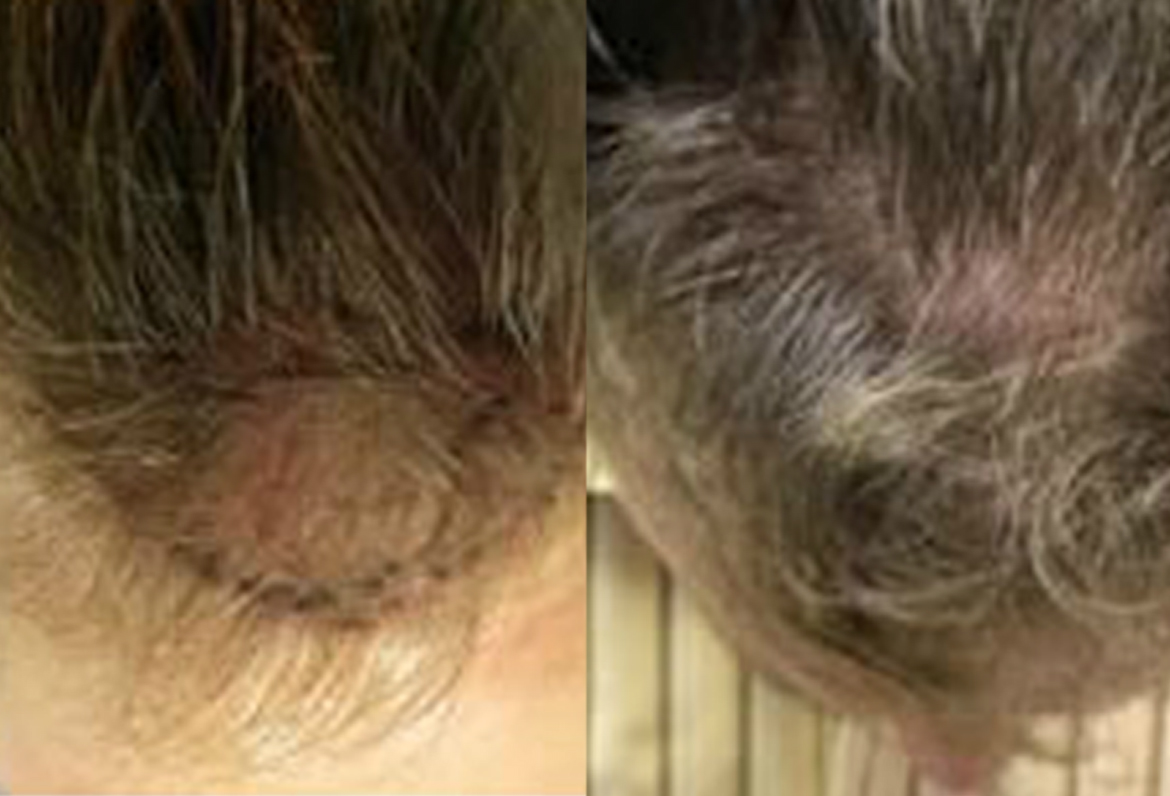 Before And After, 2000 Grafts FUE