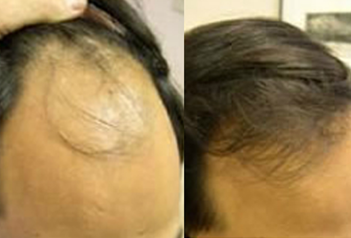 Before and After Graft Strip Procedure, 2000 Grafts