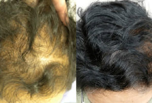 Before and After, 2000 Graft (50 Year Old Female)