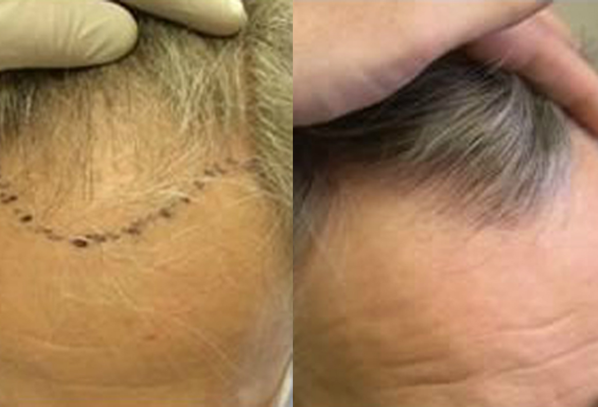 Before and After Hair Transplant Procedure, 2000 Plus Grafts