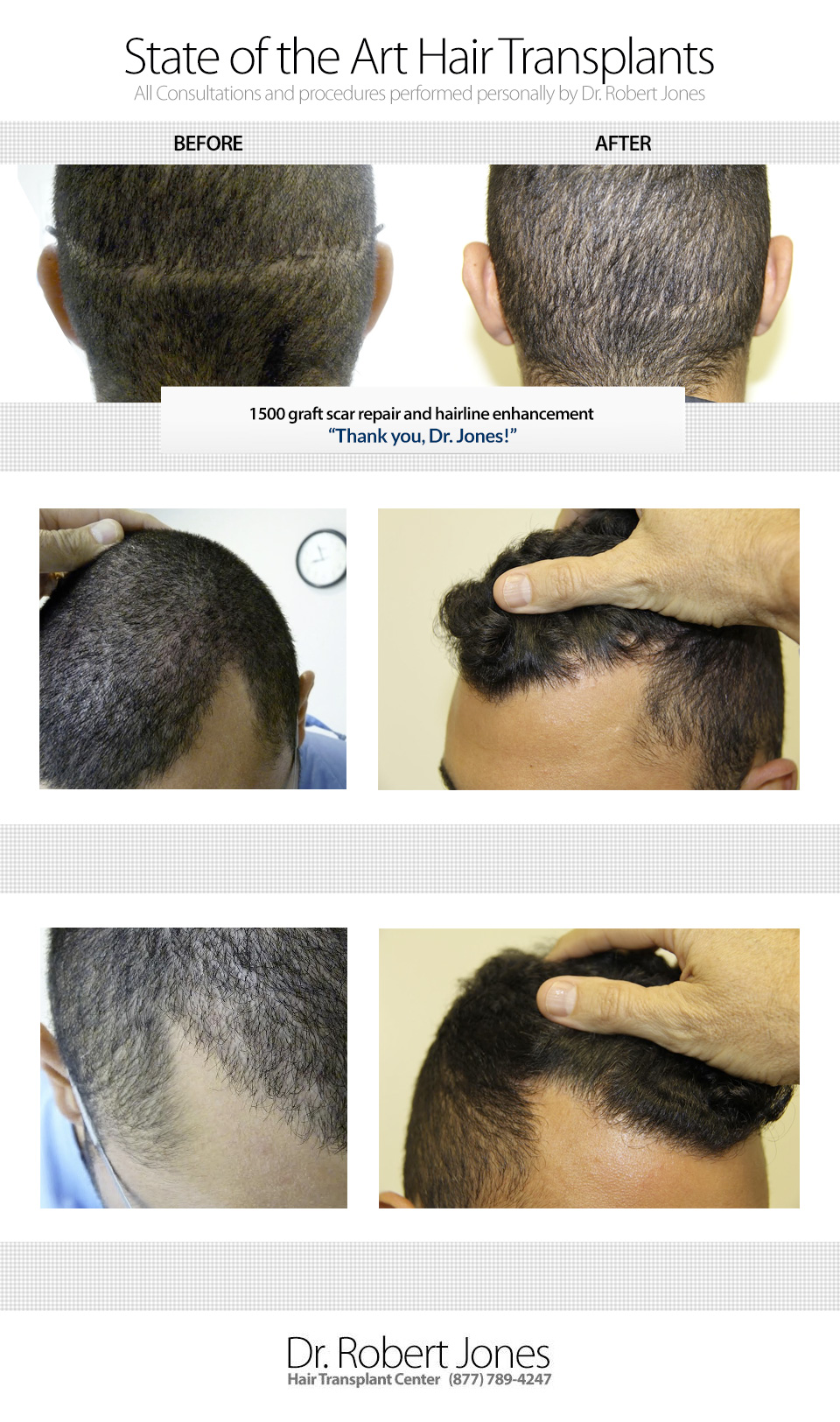 Before And After 1500 Grafts in Hairline