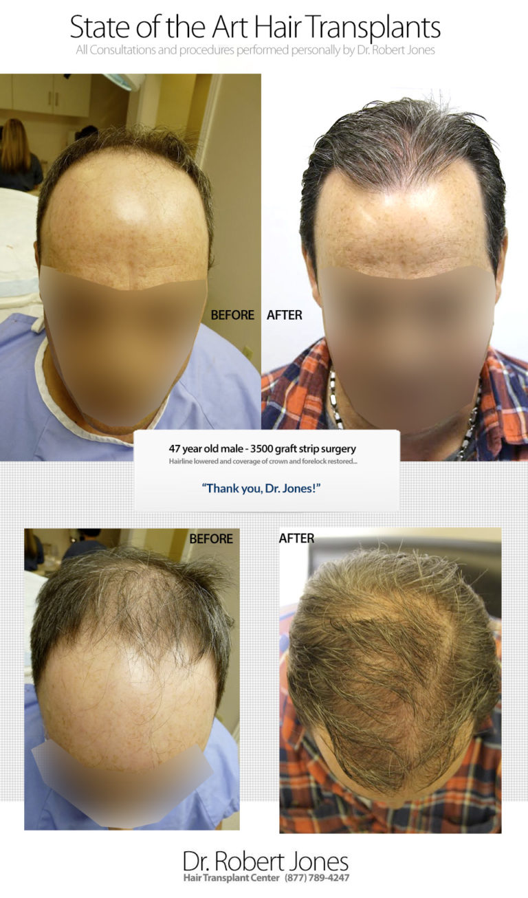 Before And After Graft Strip Surgery, 47 Year Old Male, 3500 Grafts