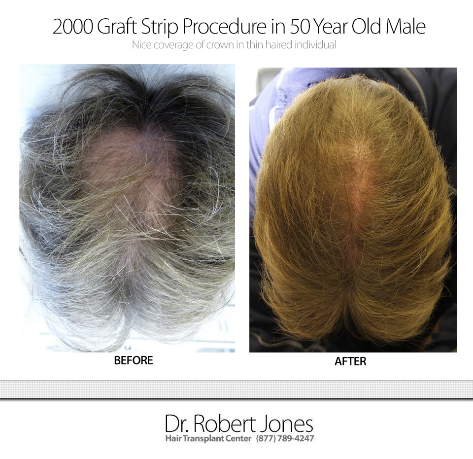 Before And After Graft Strip Surgery, 2000 Grafts