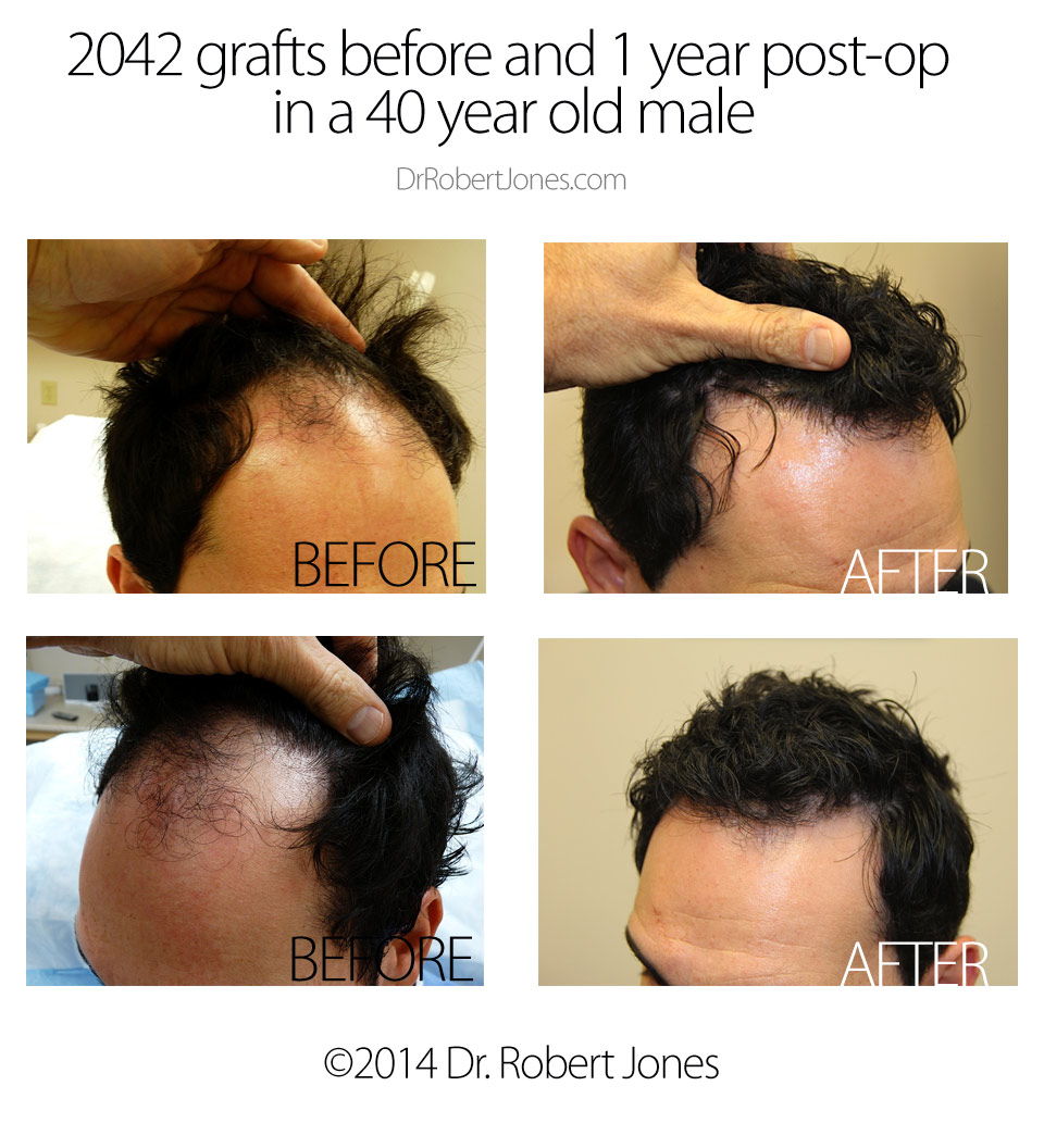 Before And After Hair Transplant Procedure, 2042 Grafts