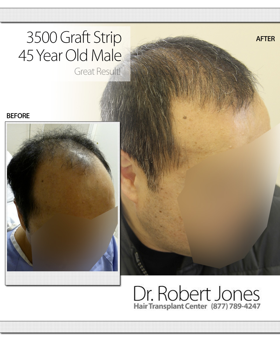 Before And After Graft Strip Hair Transplant Procedure, 45 year old male, 3500  Grafts - Toronto Hair Transplant Centre