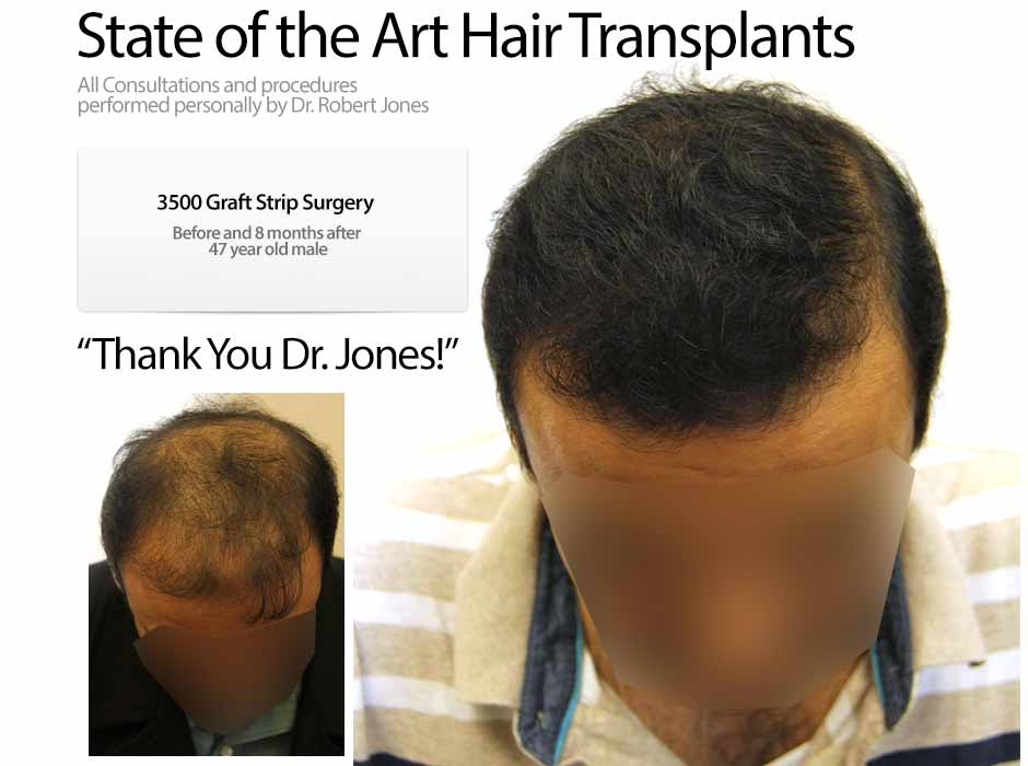 Before And After Graft Strip Surgery 47 Year Old Male 3500 Grafts Toronto Hair Transplant Centre 2002