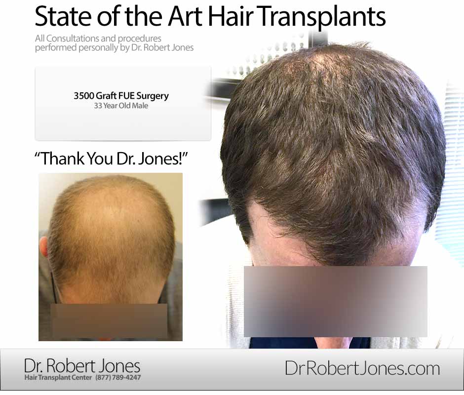 Before And After FUE Procedure, 33 Year Old Male, 3500 Grafts - Toronto Hair  Transplant Centre