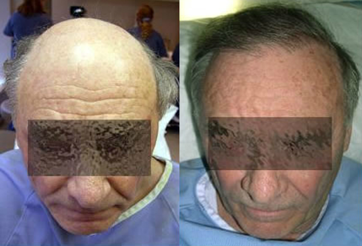 Before and After Grafts Strip Surgery, 2200 Grafts