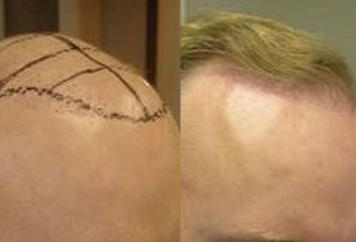 Before And After 2400 FUE Procedure