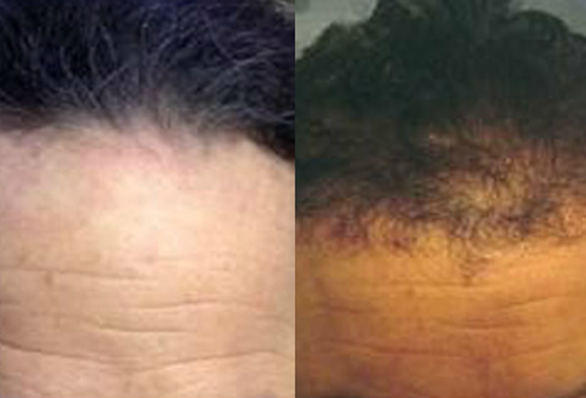 Before and After Strip Surgery 2400 Grafts in Hairline 