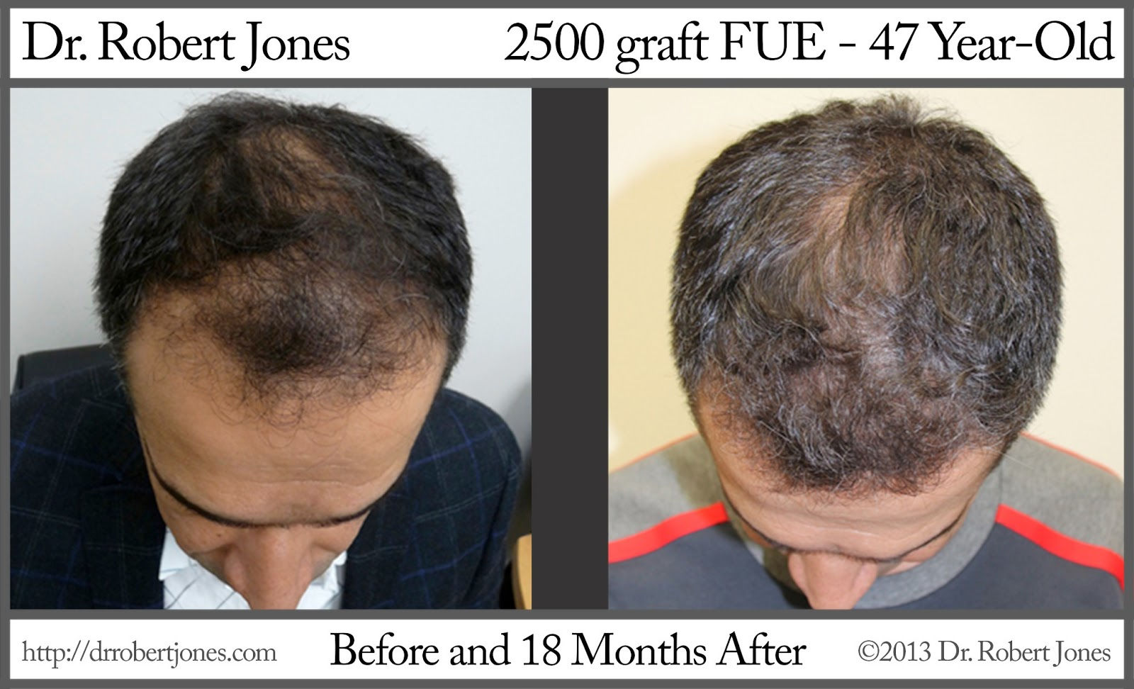 Before And After Hair Transplant Procedure, 2500 FUE Grafts