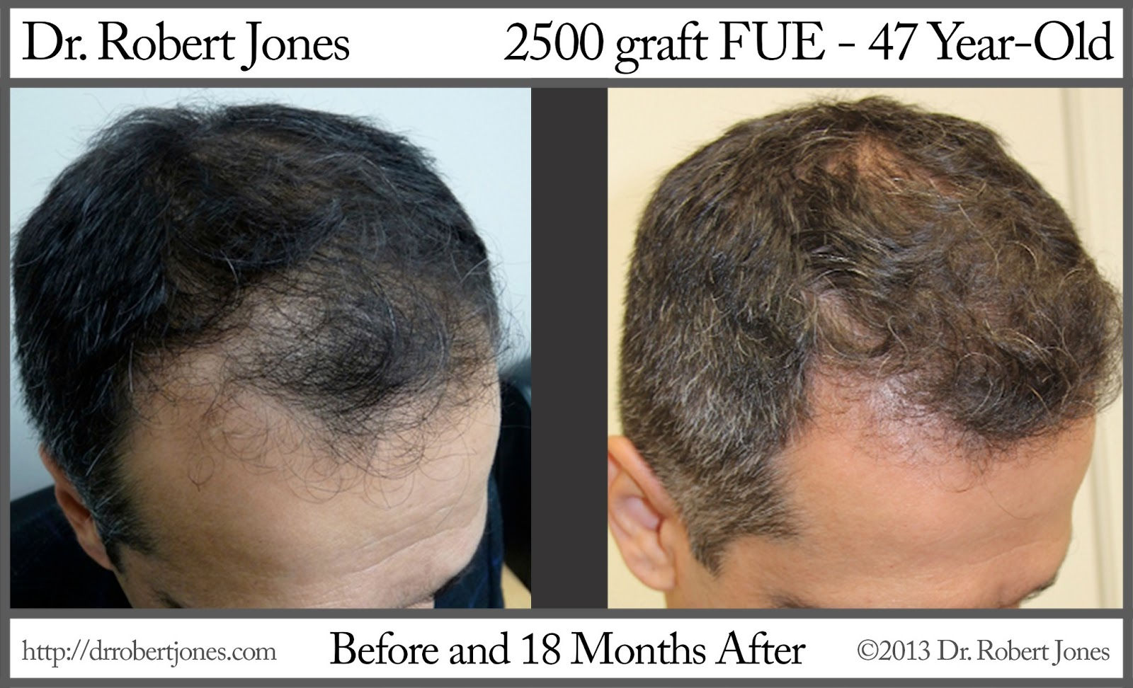 Before And After Hair Transplant, 2500 FUE Grafts