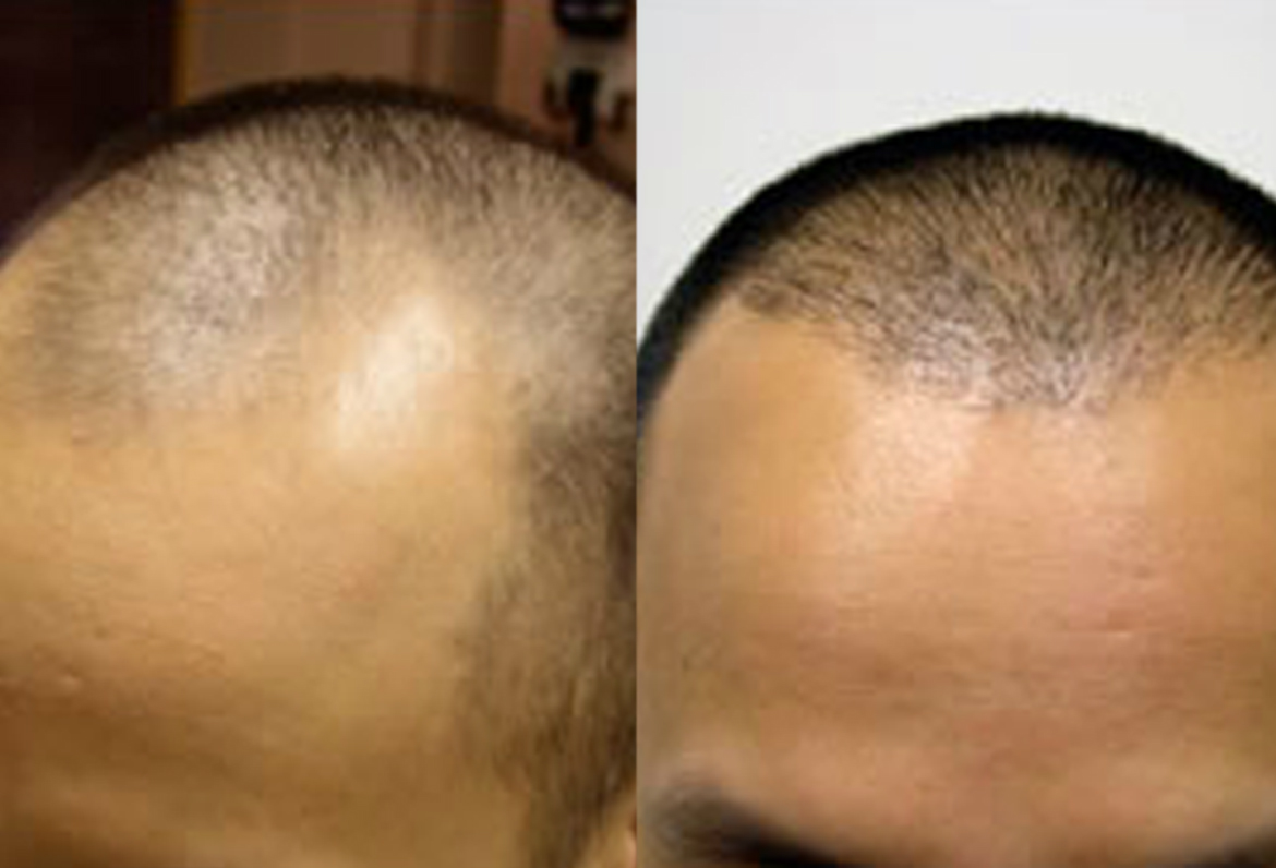 Before and After FUE Hairline Restoration, 2500 Grafts FUE