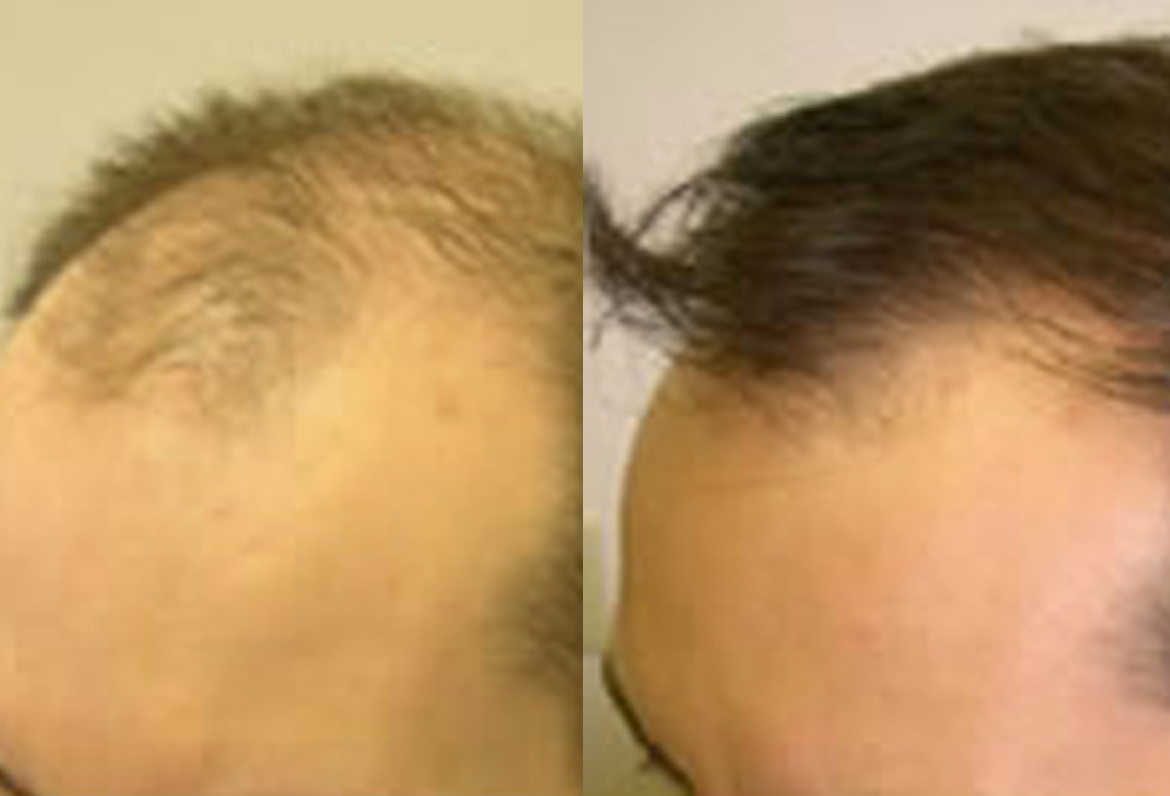 Before and After FUE Procedure, 2500 Grafts