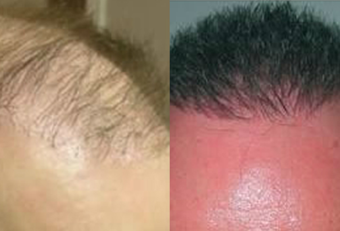 Before and After, 2500+ Grafts