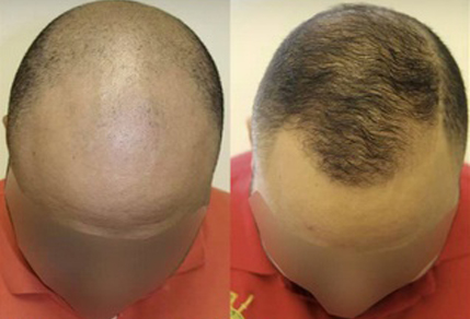 Before And After FUE Procedure, 3000 Grafts - Toronto Hair Transplant ...