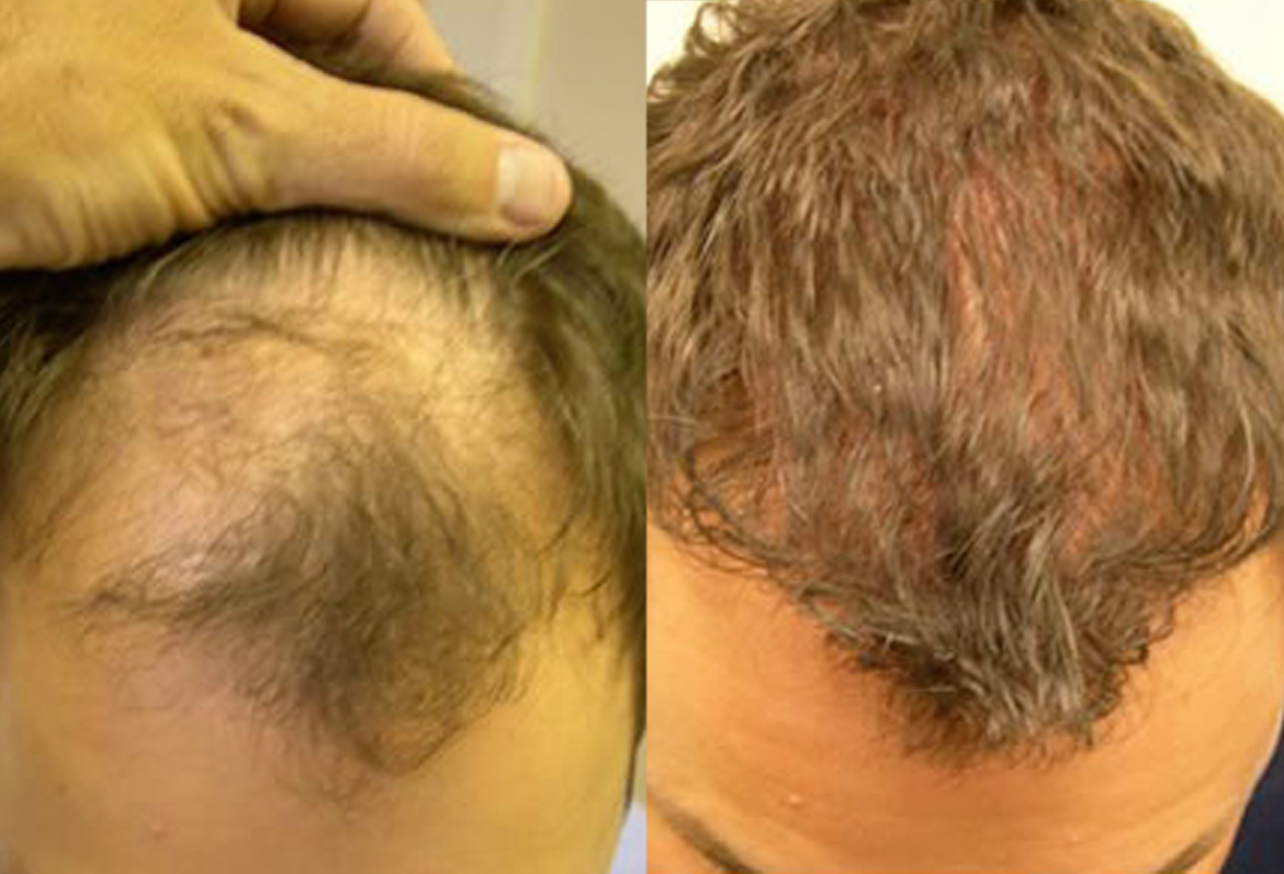 Before And After, 33 year old male, 200 grafts - Toronto Hair Transplant  Centre