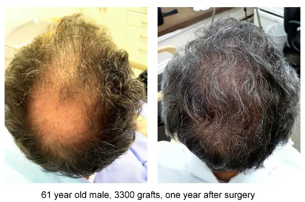 3300 Grafts,61 Year Old Male Before And After