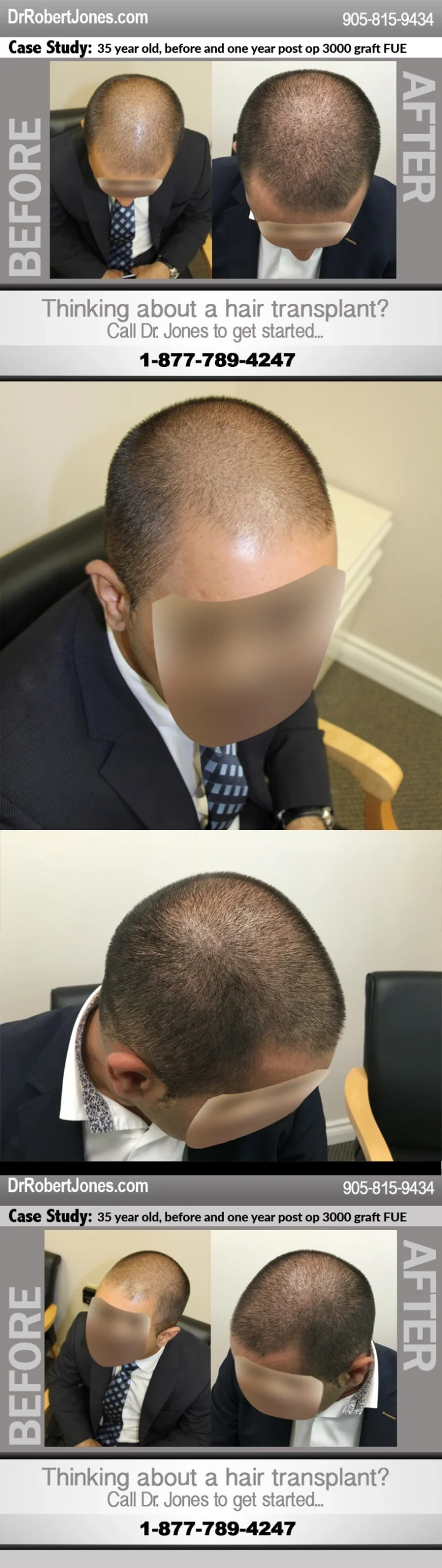 35 Year Old 3000 Graft FuE Before and After One Year Post Op  