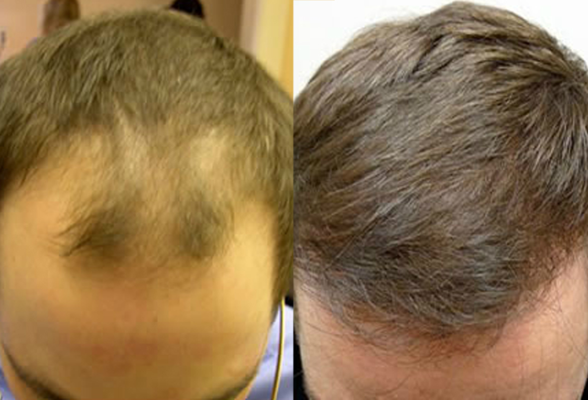 Before And After Hair Line Procedure, 35 year old male, 2500 grafts -  Toronto Hair Transplant Centre