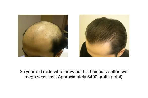 35 Year Old Male,8400 Grafts Mega Session Before And After