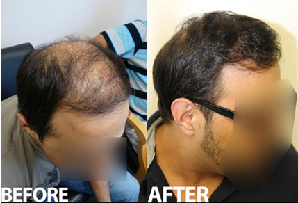 Before And After Crown Procedure, 3500 Grafts - Toronto Hair Transplant  Centre
