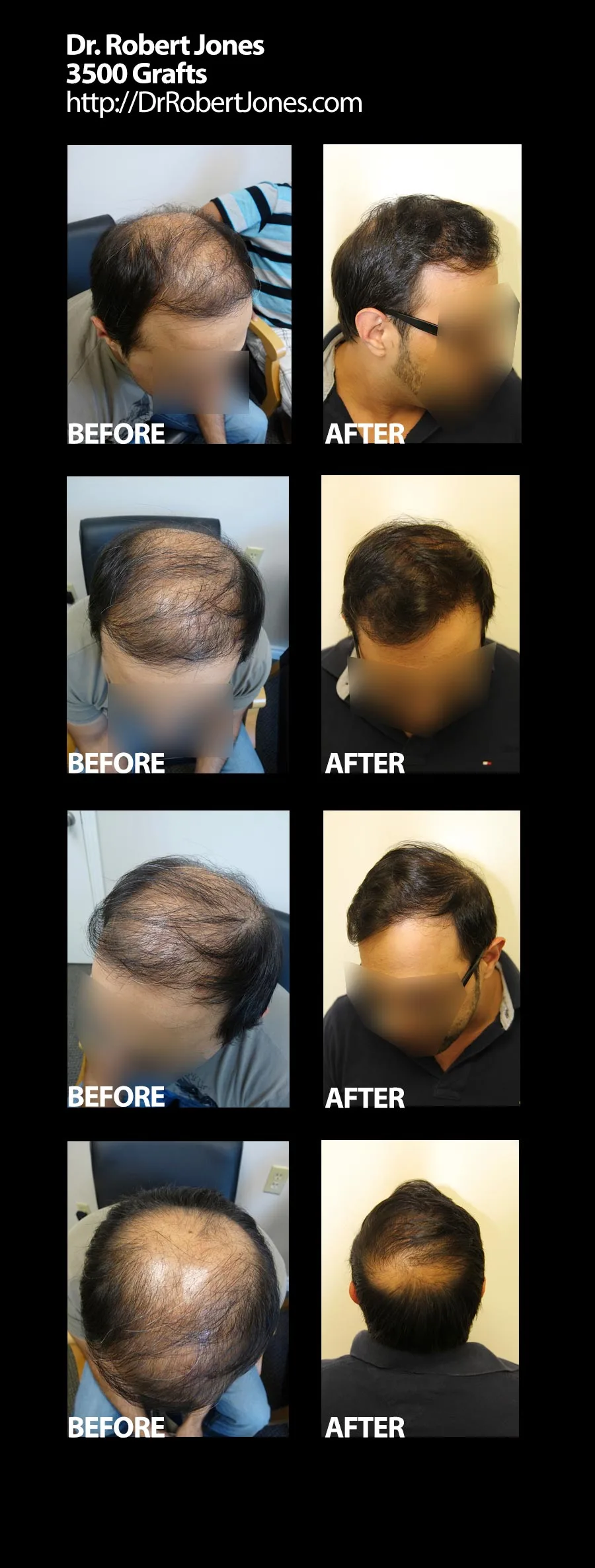 3500 Grafts, Before and After